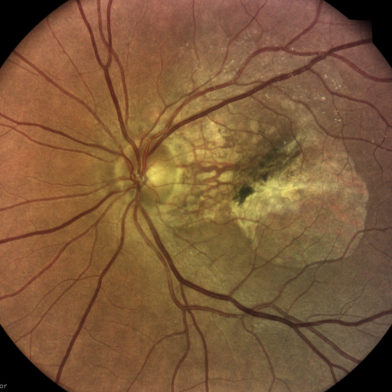 TrueColor retinal image of age-related macular degeneration (AMD) taken with iCare DRSplus