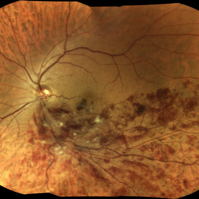 TrueColor mosaic retinal image of branch retinal vein occlusion (BRVO)