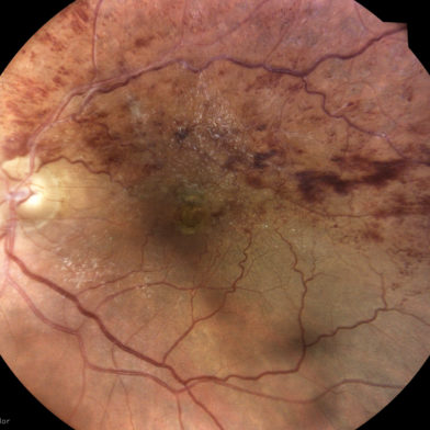 TrueColor retinal image of Branch Retinal Vein Occlusion (BRVO) taken with iCare DRSplus