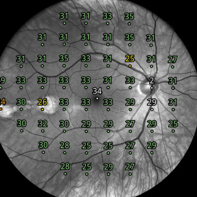 iCare COMPASS visual field image