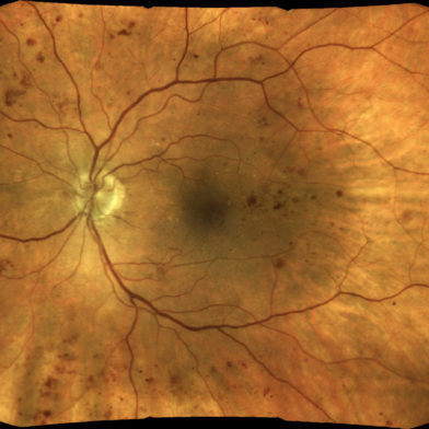TrueColor mosaic retinal image of diabetic-retinopathy