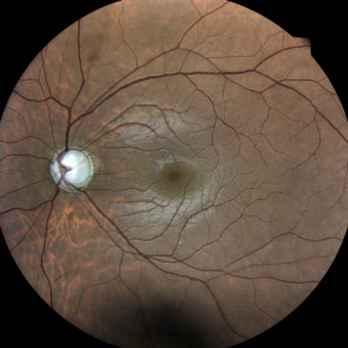 TrueColor retinal image of glaucoma